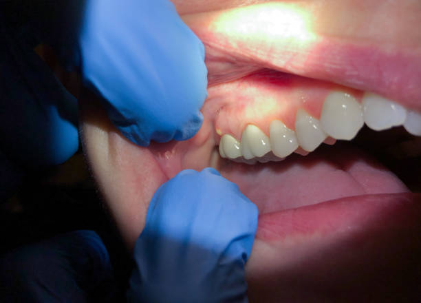 Best Emergency Dental Filling Replacement  in Broad Brook, CT